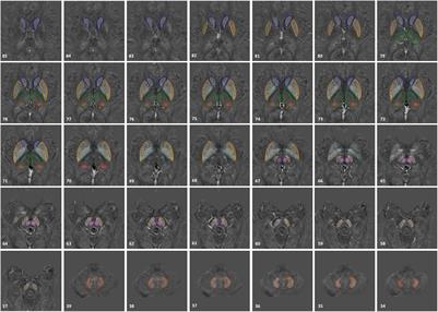 Regional High Iron in the Substantia Nigra Differentiates Parkinson’s Disease Patients From Healthy Controls